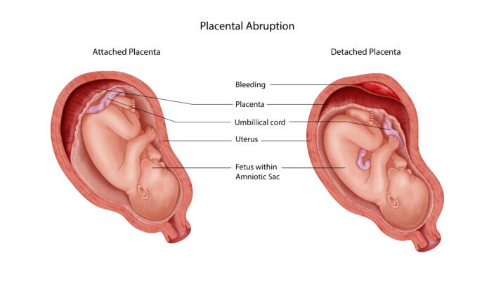 placenta-separation-in-the-first-second-third-trimester